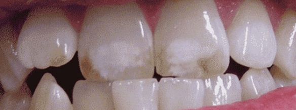 Флюороз – приобретенный порок твердых тканей зуба